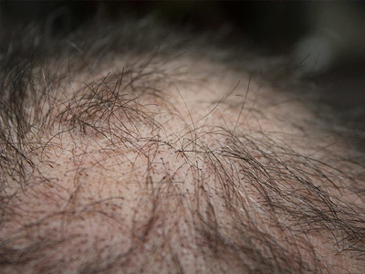 Haarausfall: Mittel gegen Haarverlust